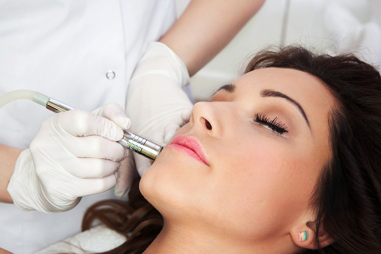 Microdermabrasion