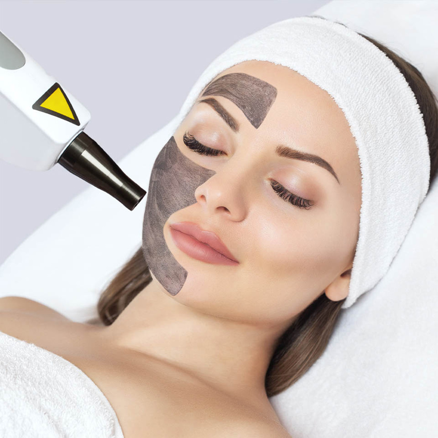 carbon laser peel