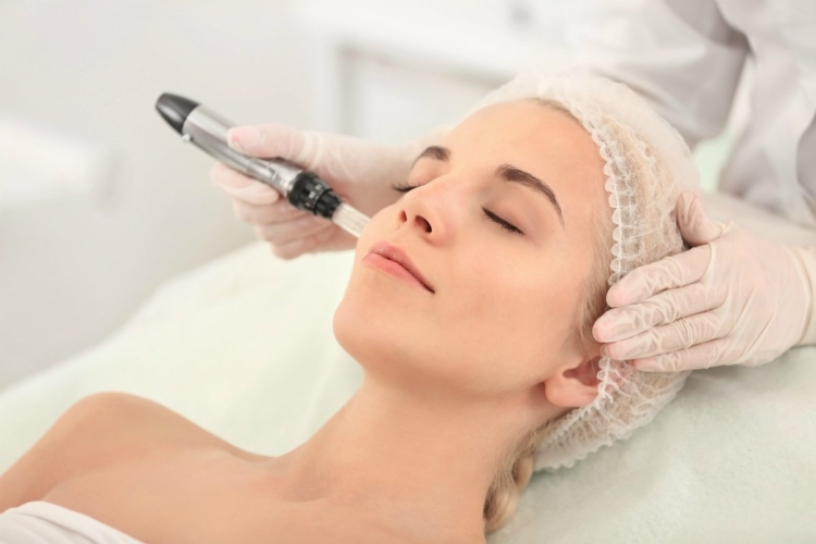 RF Microneedling treatment