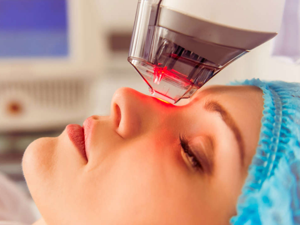 RF Microneedling treatment