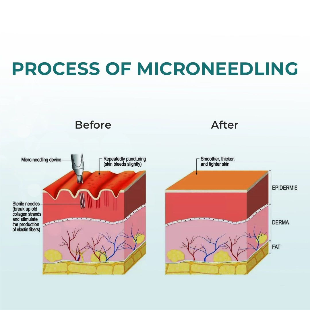 RF Microneedling Face with Exosomes treatment results
