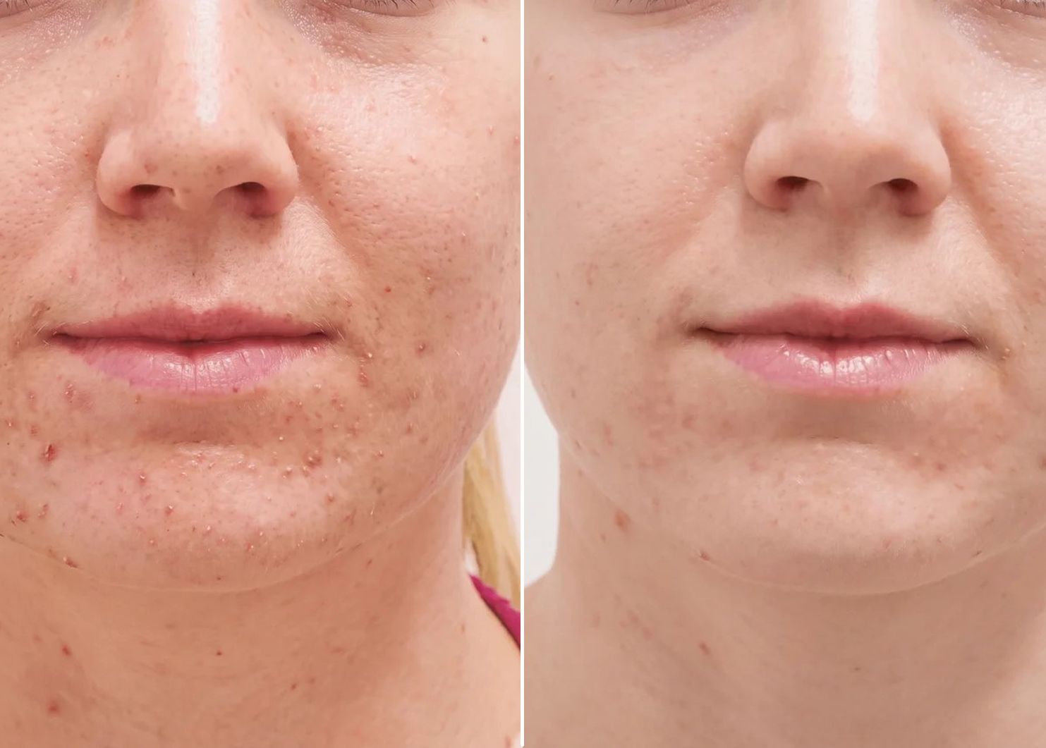 RF Microneedling before and after