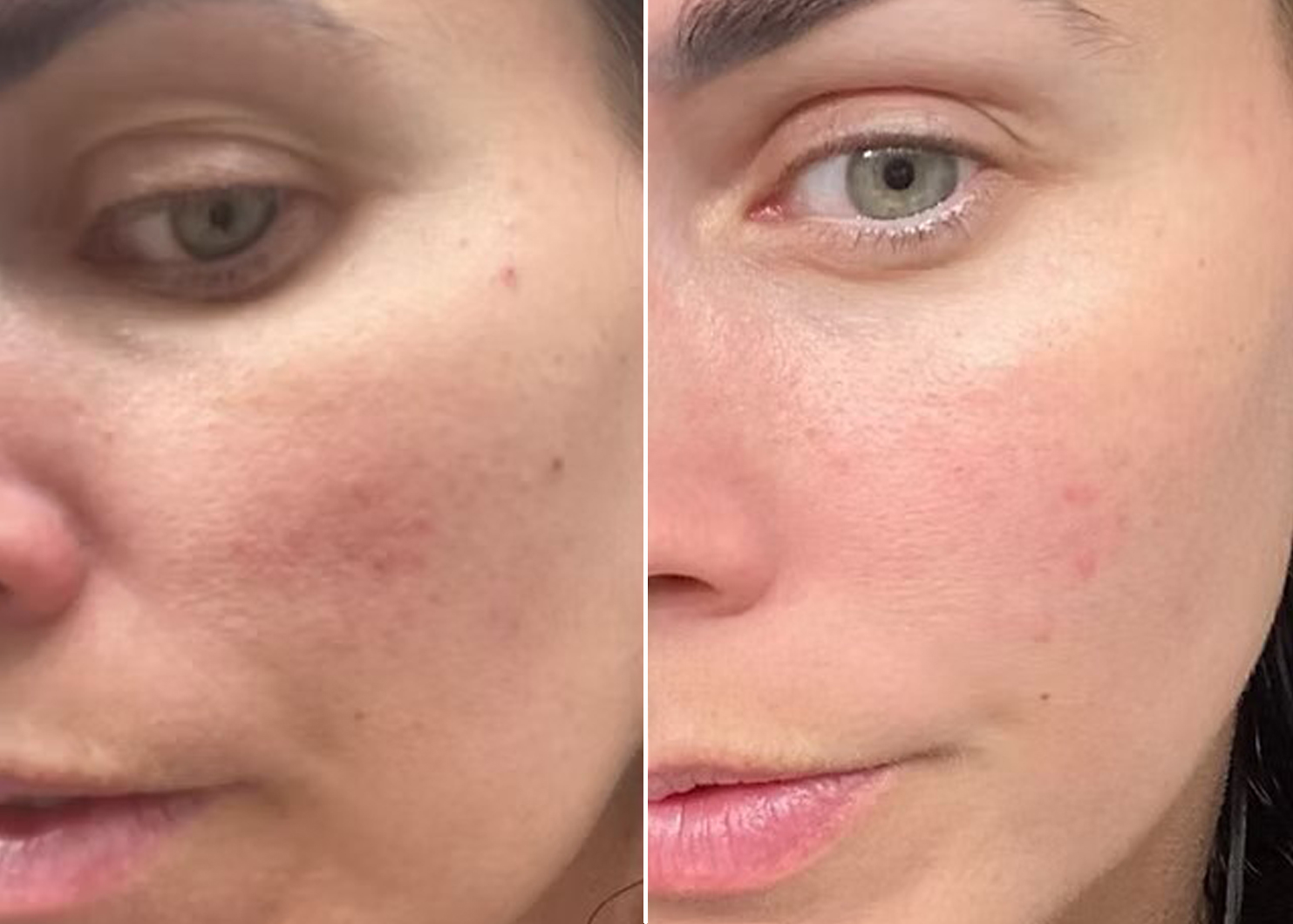 Hollywood Carbon Laser Peel face treatment results