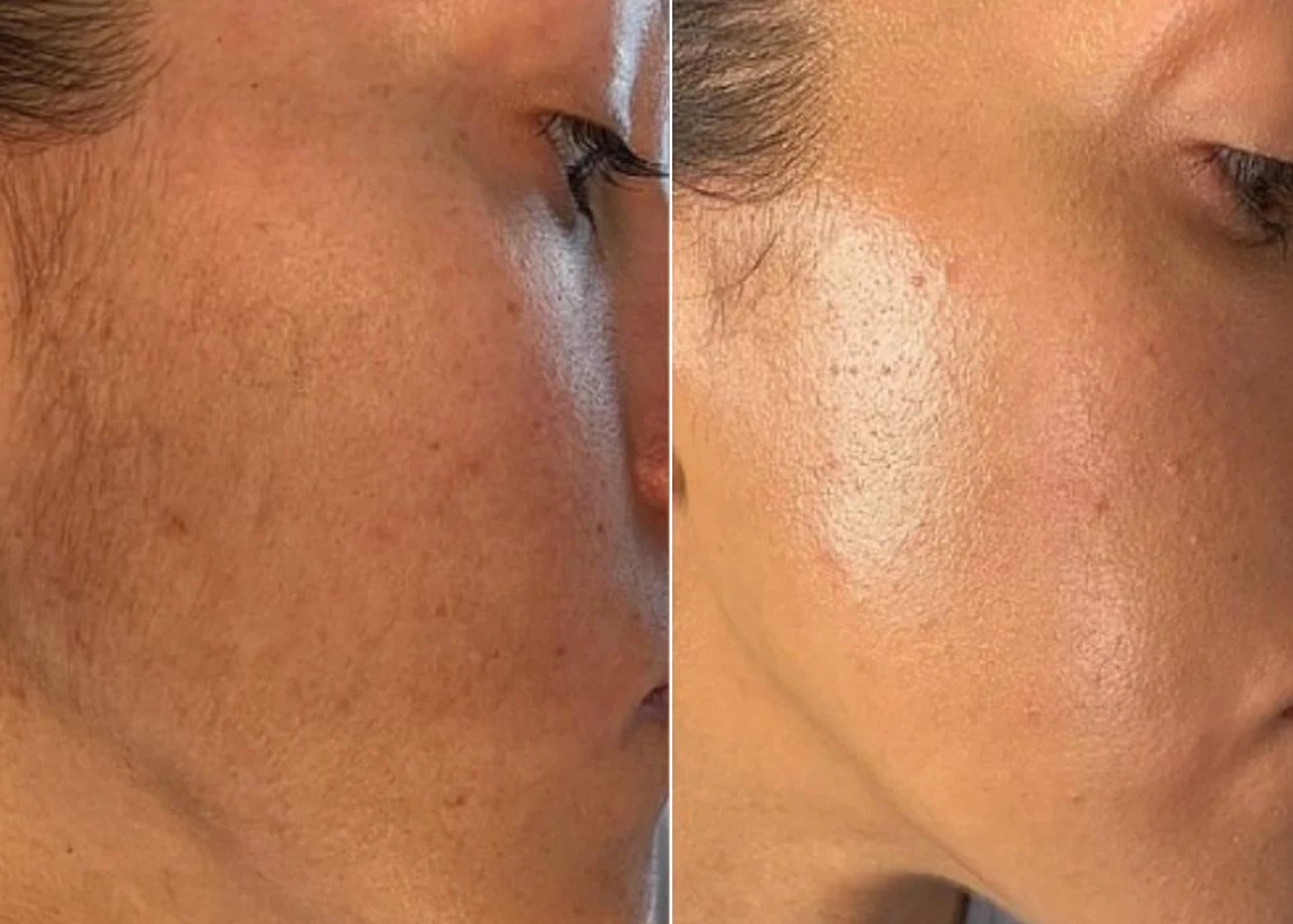 Dermaplaning before and after
