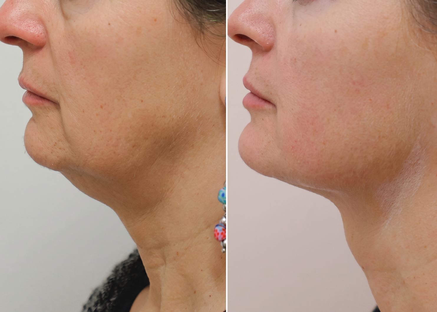 HIFU skin tightening before and after