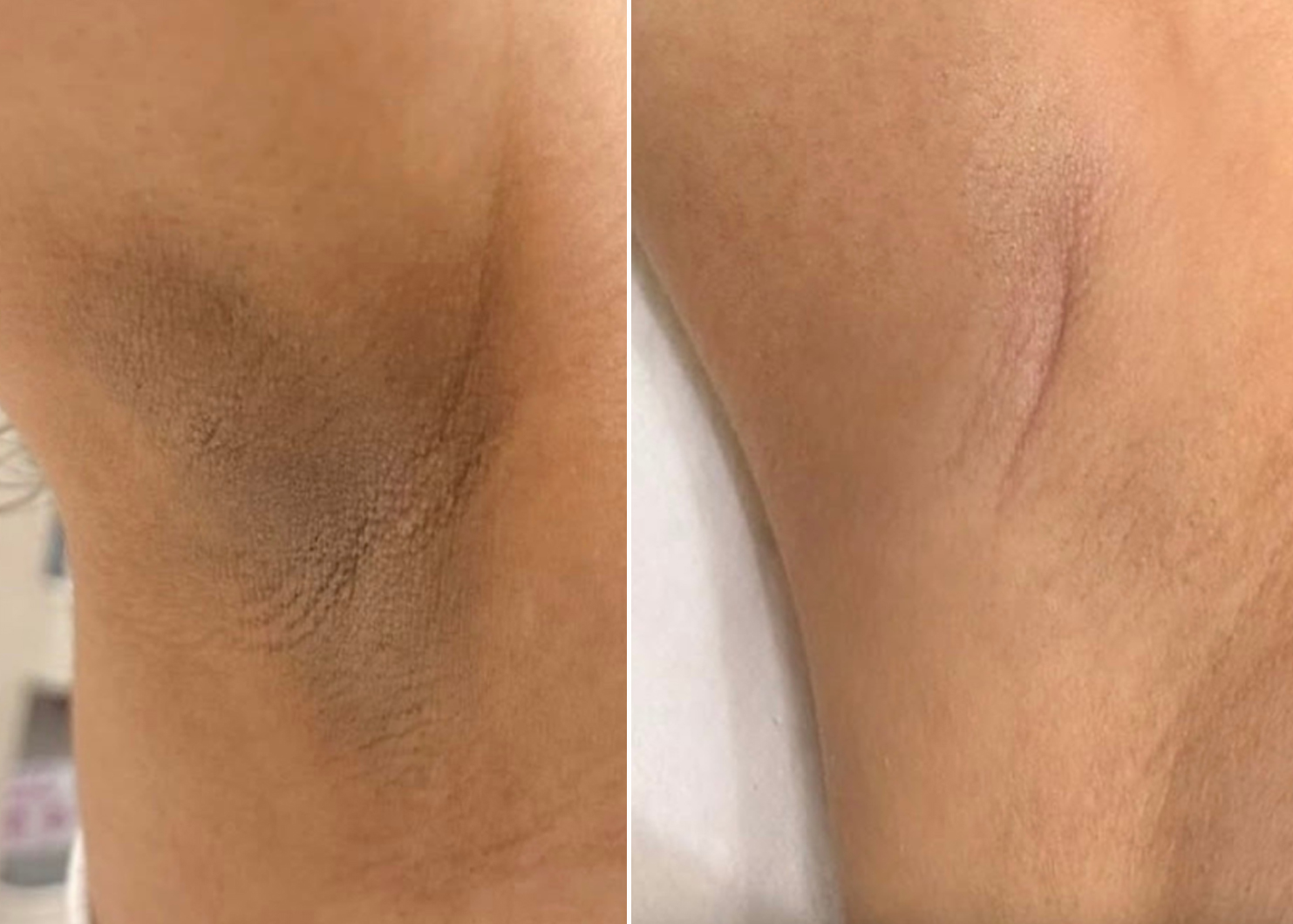 Natural intimate pigmentation skin lightening treatment results