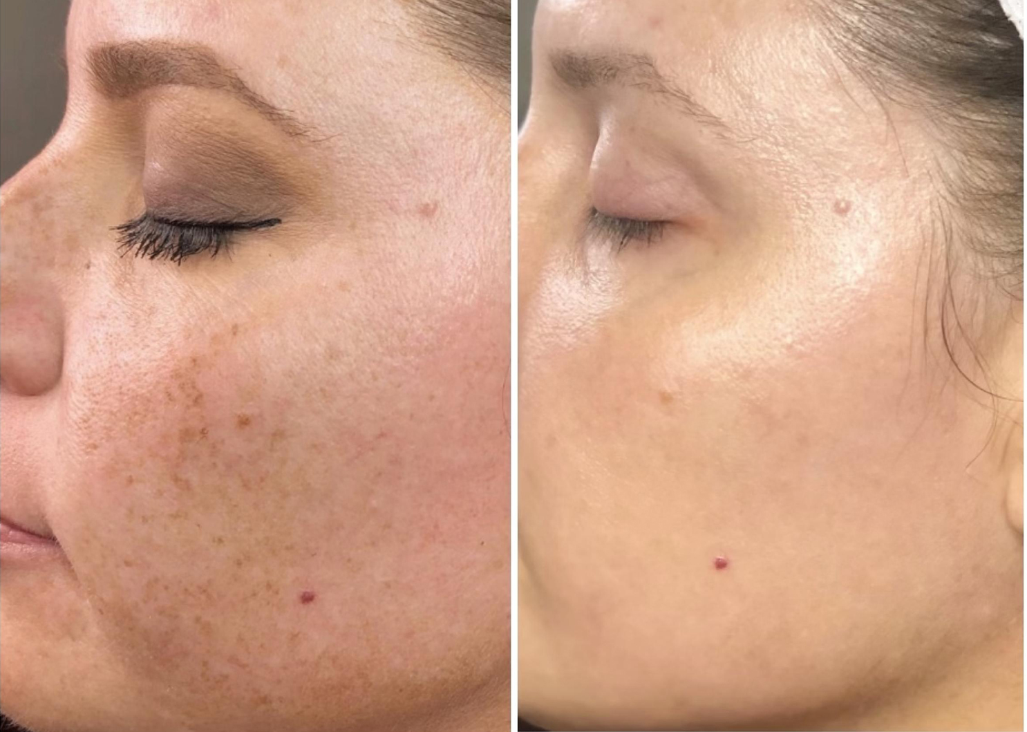 IPL PhotoFacial before and after