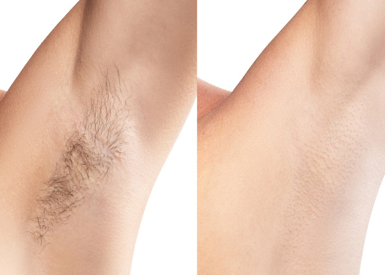 Laser hair removal before and after