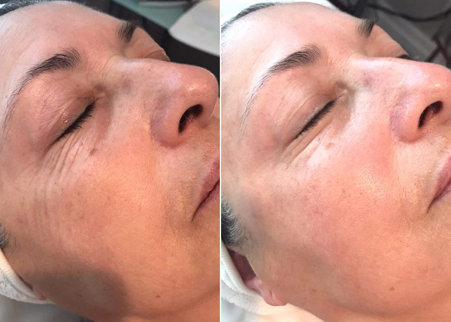 Microneedling and nano needling before and after results
