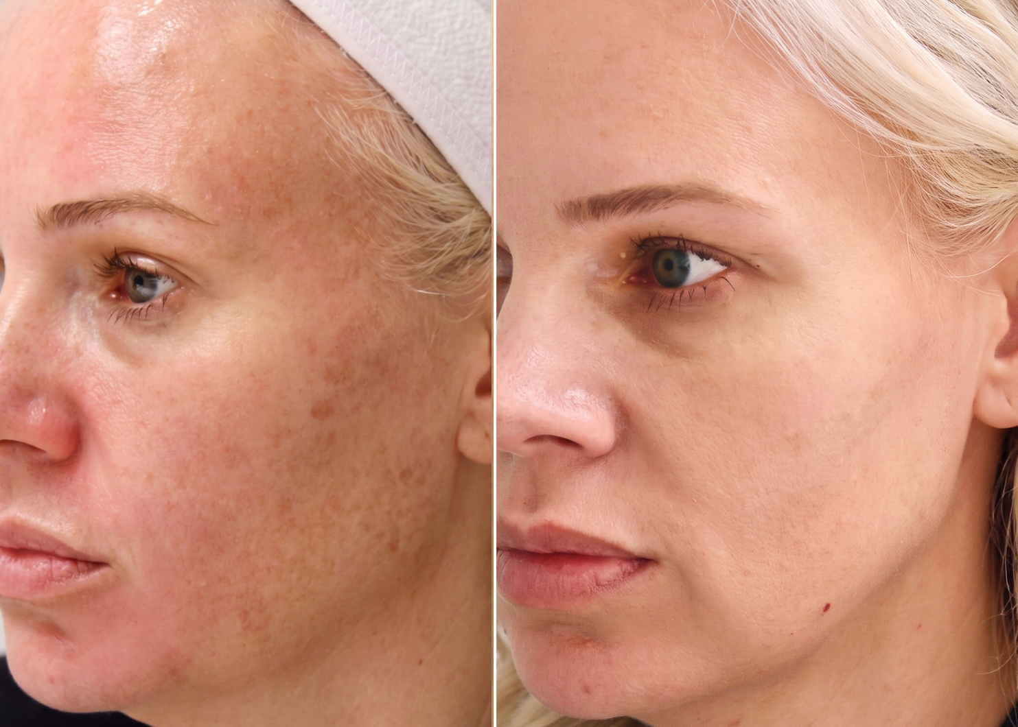 Professional Bio Peel and Chemical Peel treatment results