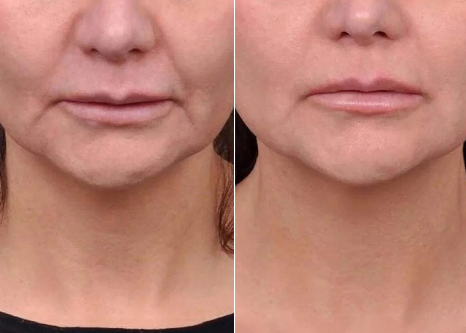 RF Face Lift before and after results